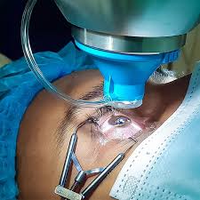 LASIK Surgery